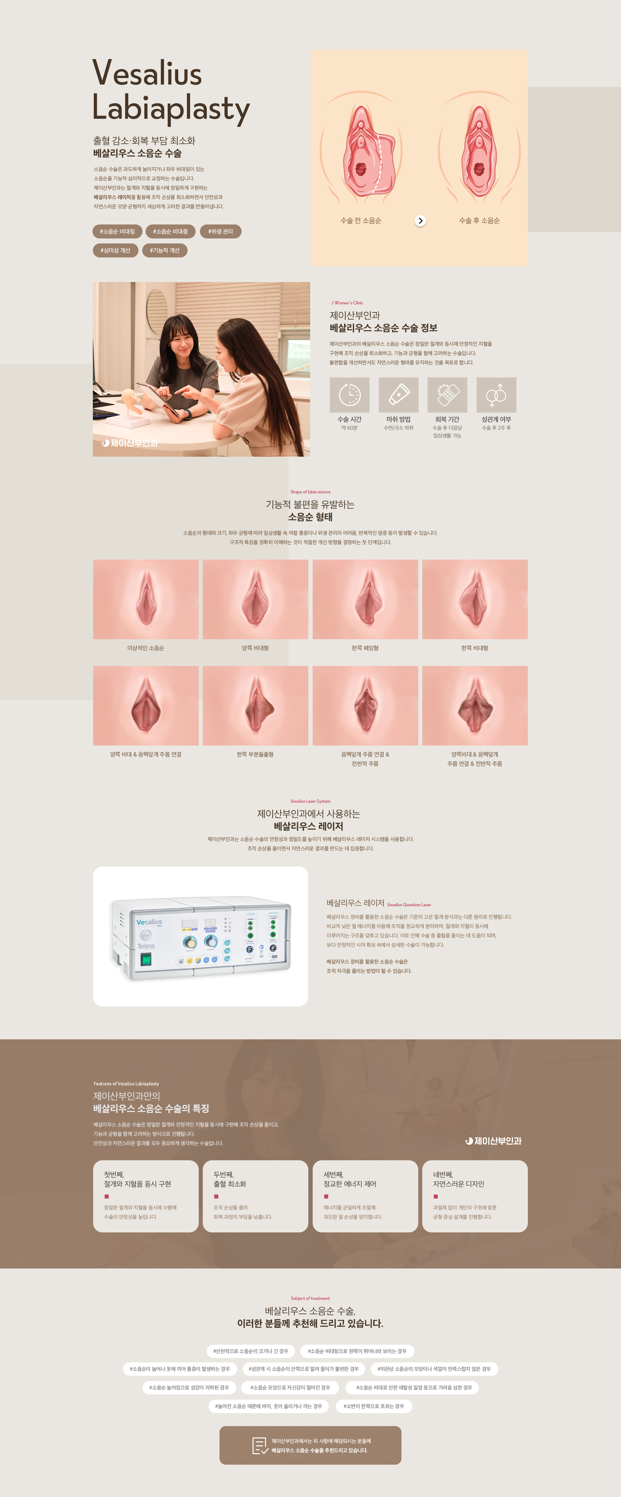 베살리우스 소음순 수술